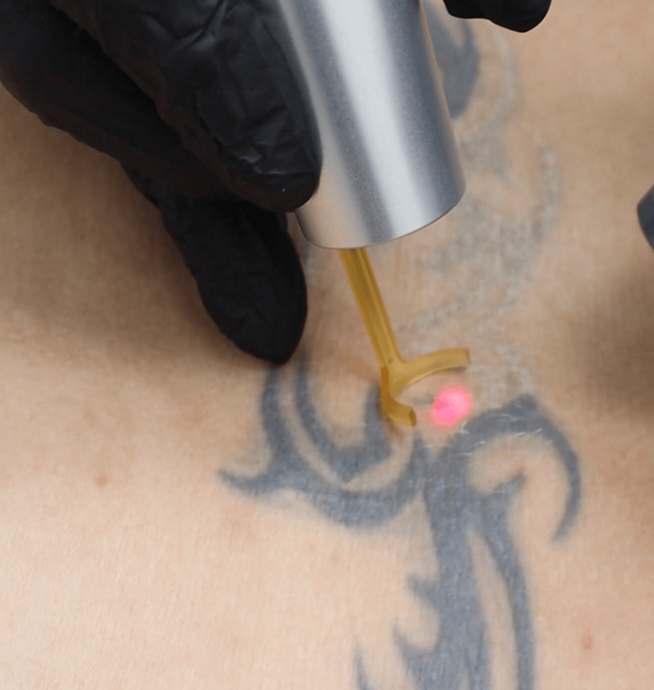 Tattoo removal results at X-TAT