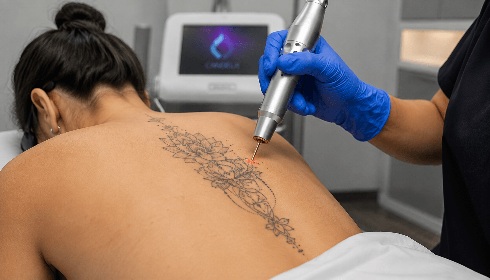 Laser tattoo removal treatment at X-TAT Boca Raton